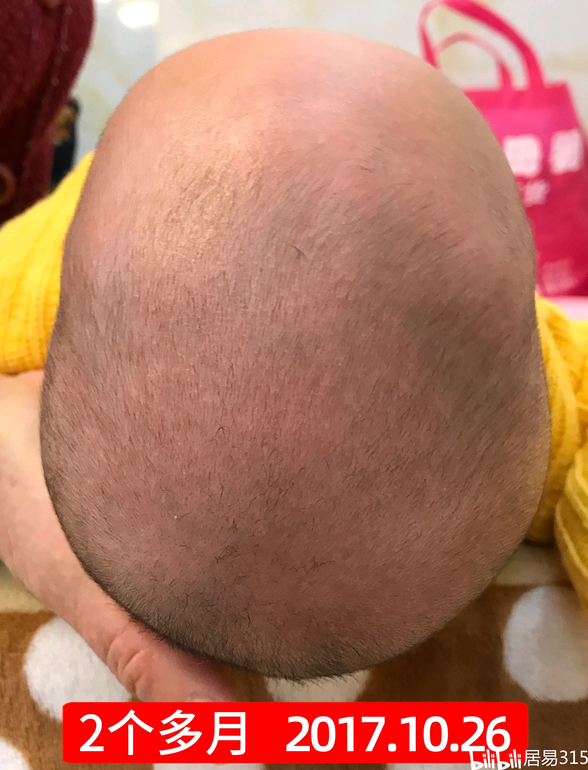 婴儿小圆头控颜术近2个月宝宝尖头舟状头矫正头型实录