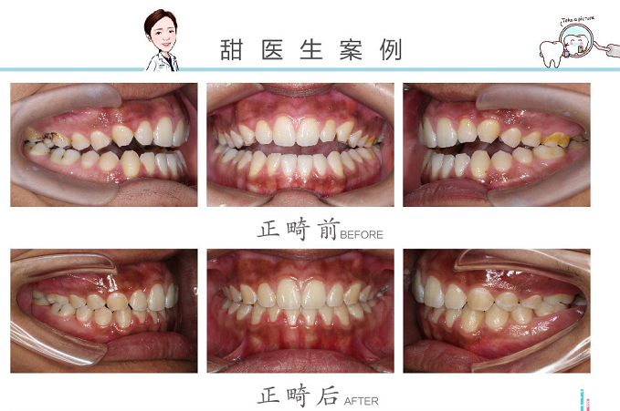 郑州牙齿矫正曹甜正畸案例集:隐适美矫治牙齿开合,侧貌更协调,咬合