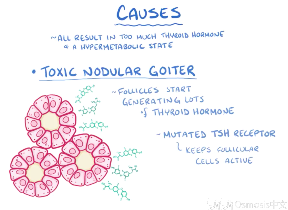 causes: toxic nodular goiter