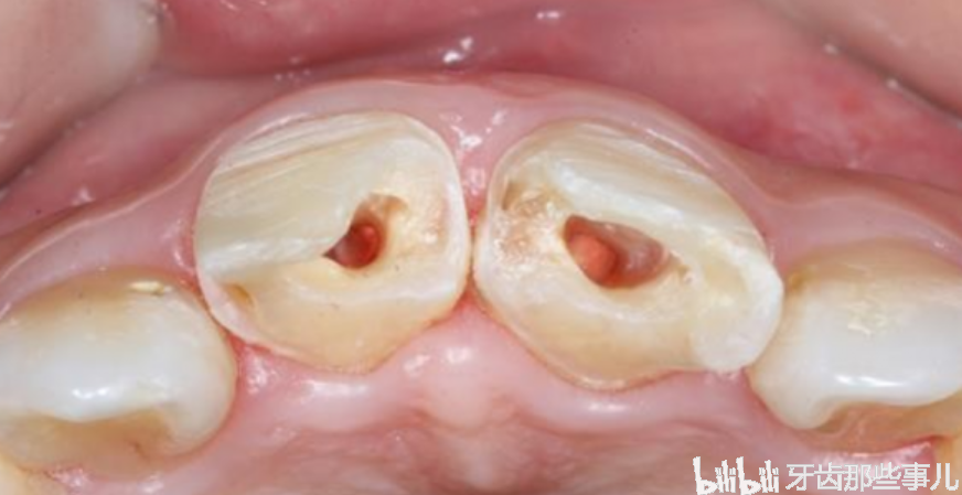 小小牙医告诉你,前牙外伤导致牙冠折断后,该如何修复.