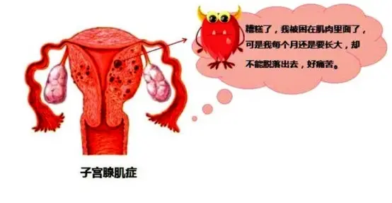得了子宫腺肌症还能怀孕吗