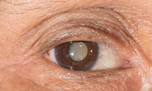 白内障手术后视力模糊是暂时的吗？如何恢复？