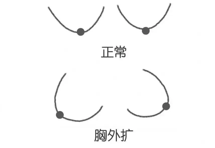 胸外扩