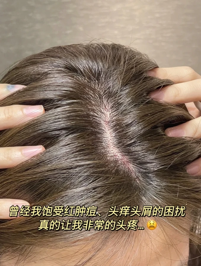 怎样快速去除头皮屑不用洗头 c5c21d3e05f2e7f0f8bc0be9278667e53546979049146466.png@1192w