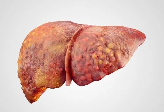 粉刺瘤是什么原因造成的 d3f57d36ae5729a2eb9a13fbed4000e41282300581.jpg