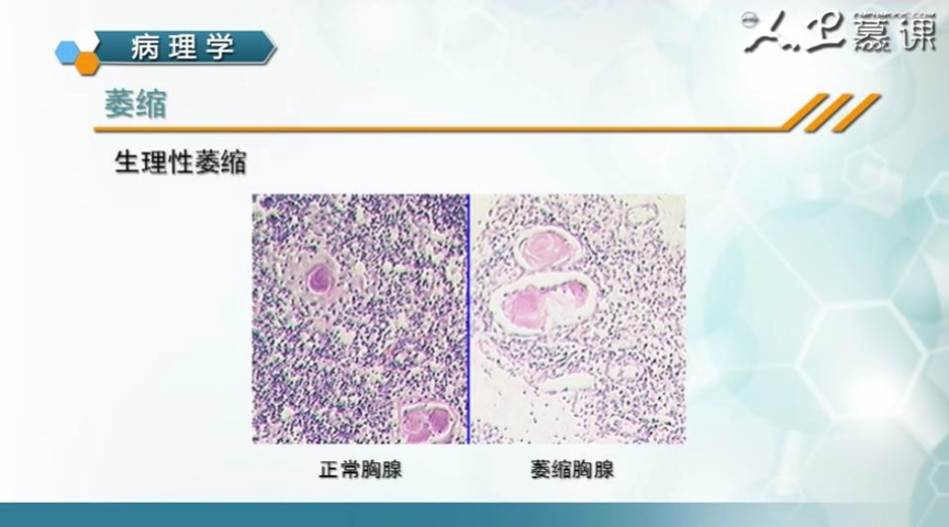 (淋巴细胞数量减少 胸腺囊体成囊状)