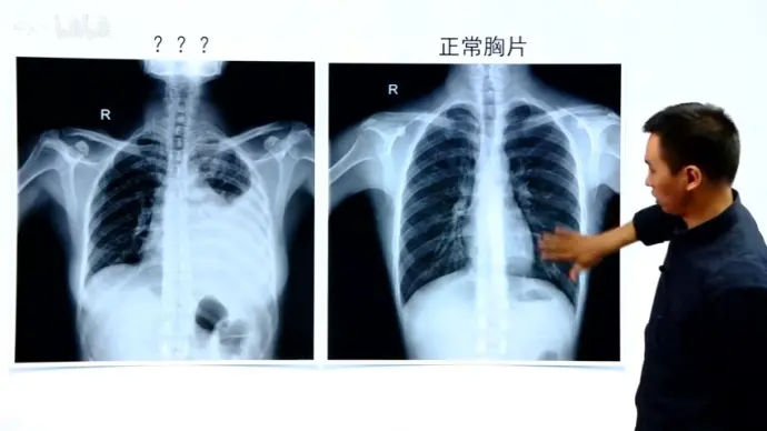x线影像学检查——胸部x线