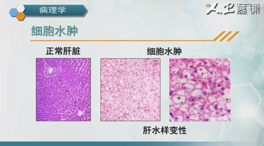 正常肝脏细胞排列整齐    气球样变