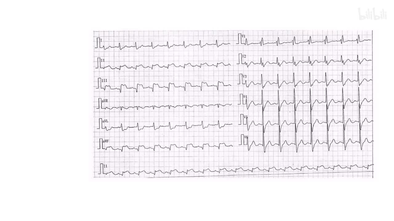 3/8) 心梗的定位怎么会难记？