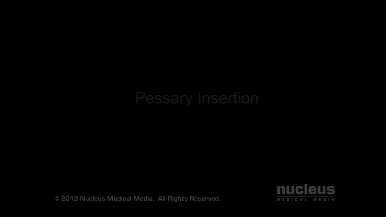 子宫托插入术治疗子宫脱垂及失禁 65-Uterine Prolapse and Incontinence Treatment Pessary Insertion