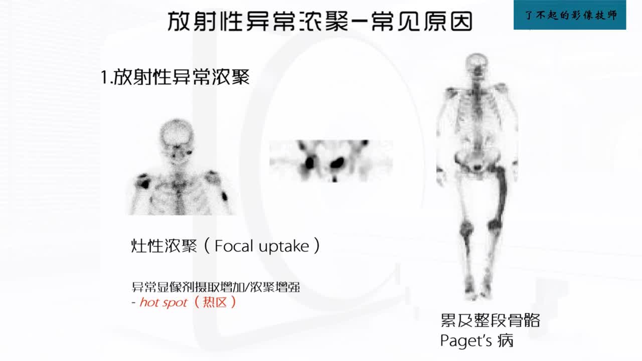 [11.1.1]--11.1 骨显像2