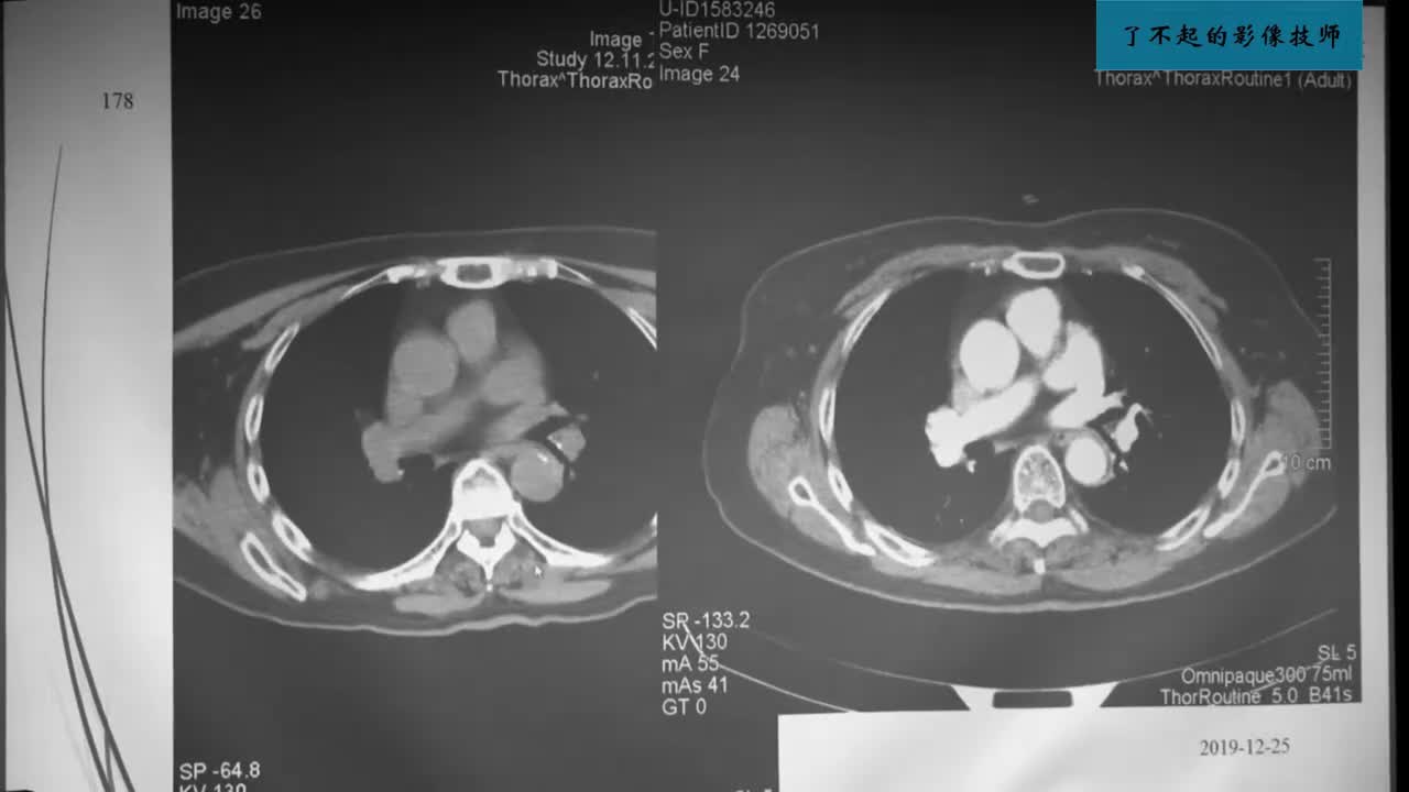 1.3 X线、CT、MR成像（三）2