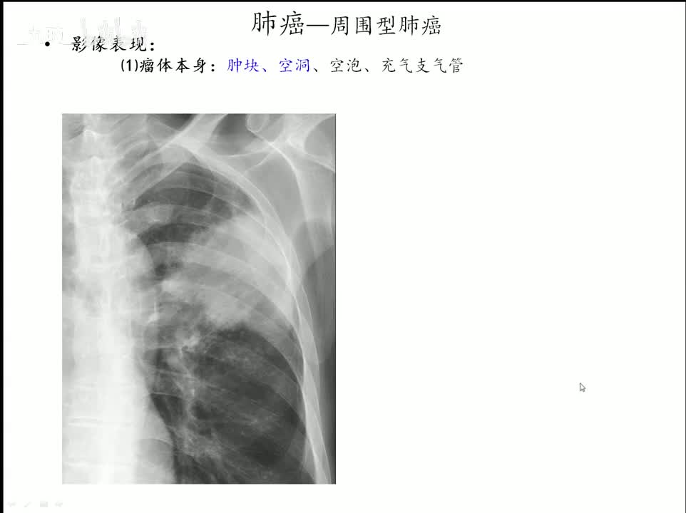 18 呼吸-8-疾病诊断5-肺癌