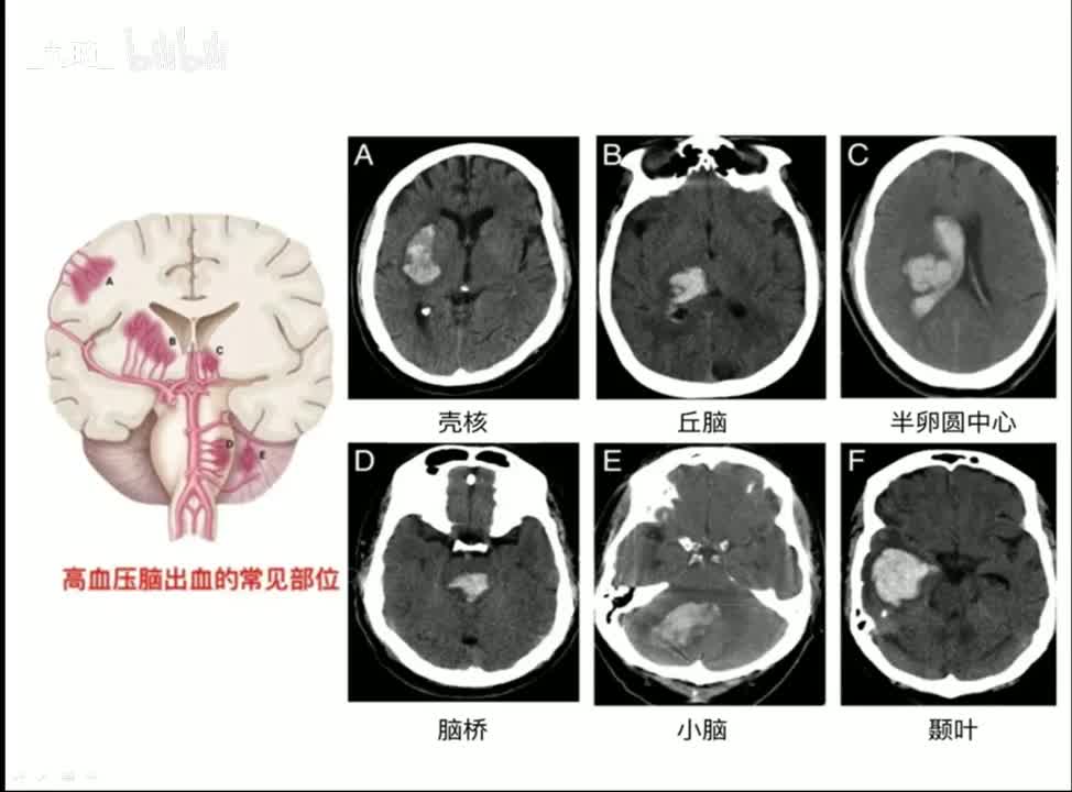 08 中枢-3-脑梗死