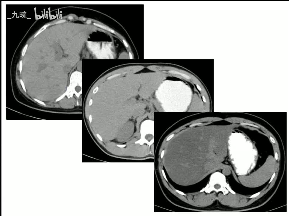 26 消化-6-肝硬化、肝癌、肝血管瘤