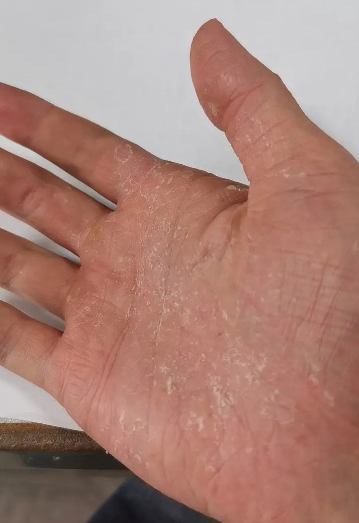 汗疱疹后期会脱皮明显,注意保湿润肤,涂护手霜
