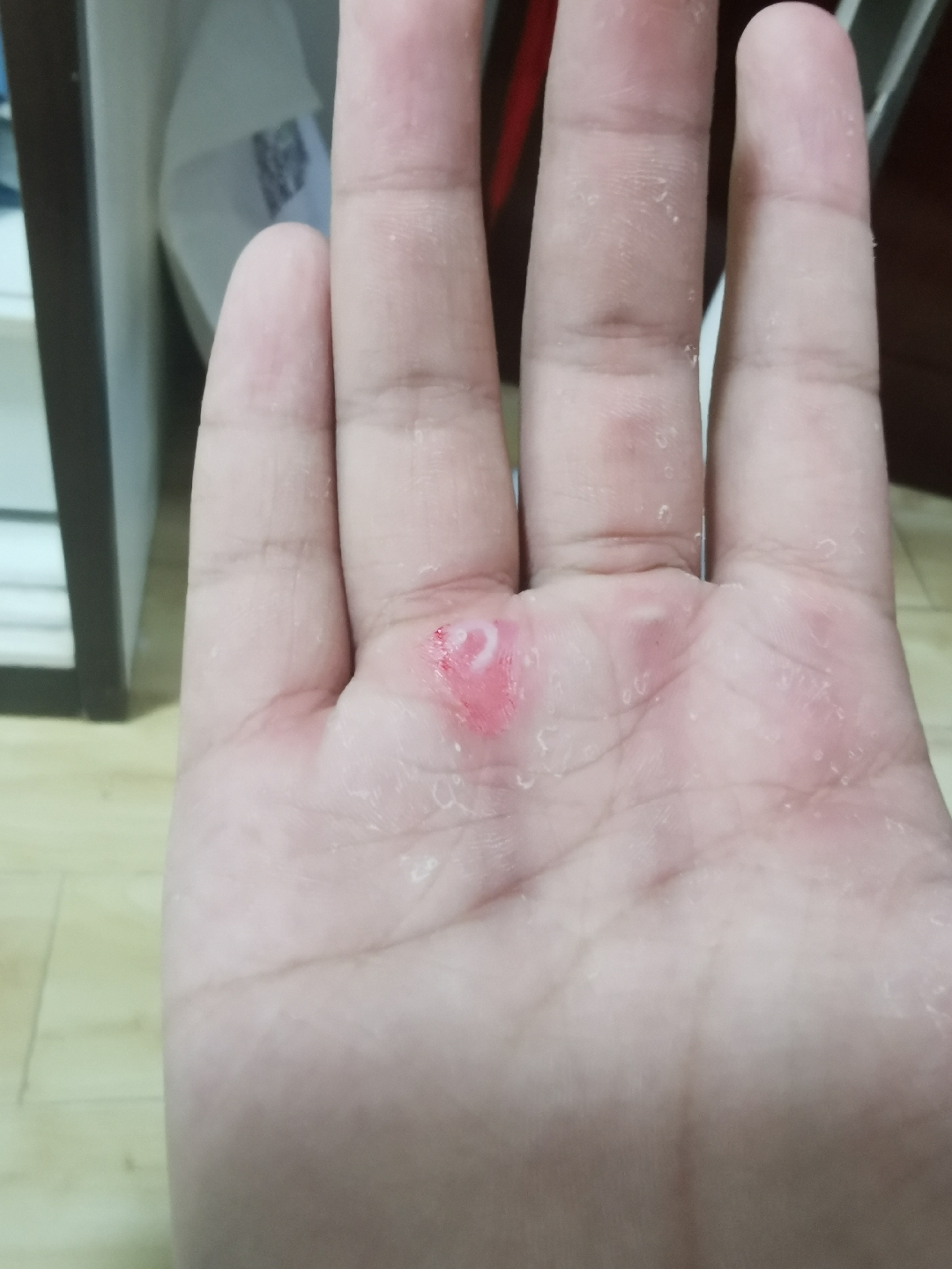 引体向上练出血泡来了,掉下来一块新西兰(地图)般的皮,疼死了啊啊啊