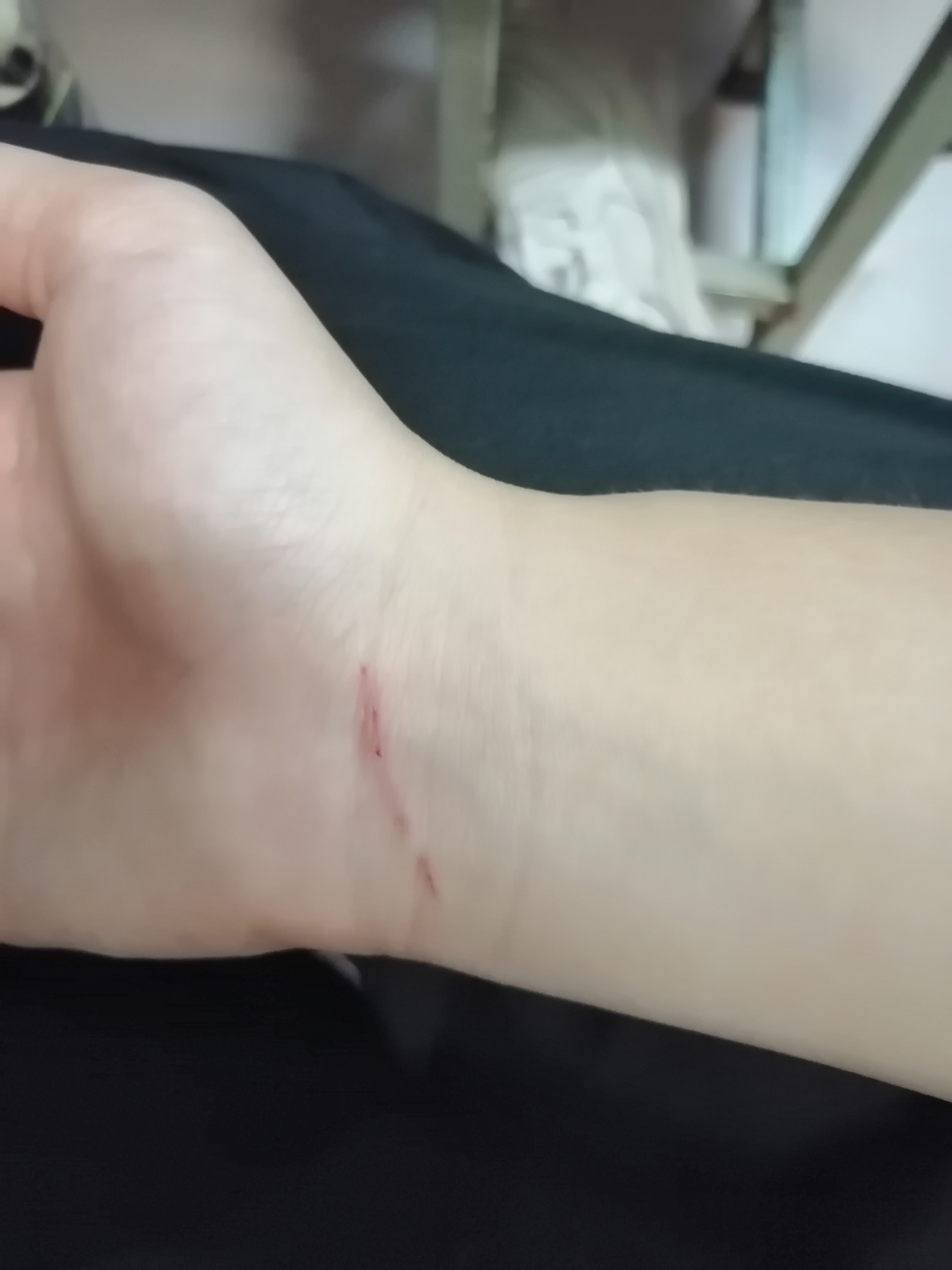 割腕自杀了 今天帮同学搬箱子结果把手腕划了一道