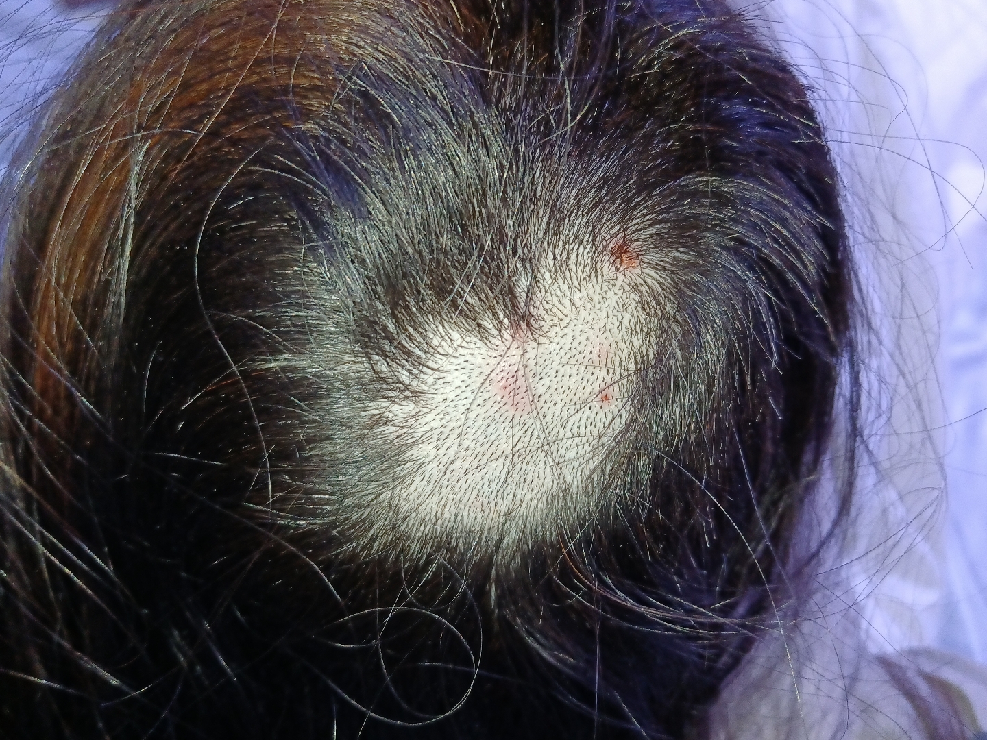 一个毛孔三根毛.怪不得头发多,腿毛也多.