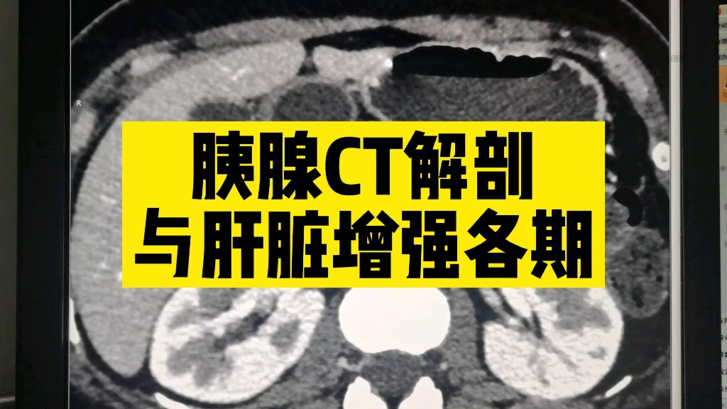 【基础知识】胰腺解剖,胰头、钩突、胰颈,肝脏增强各期如何快速识别.适用于影像入门和临床医生.哔哩哔哩bilibili