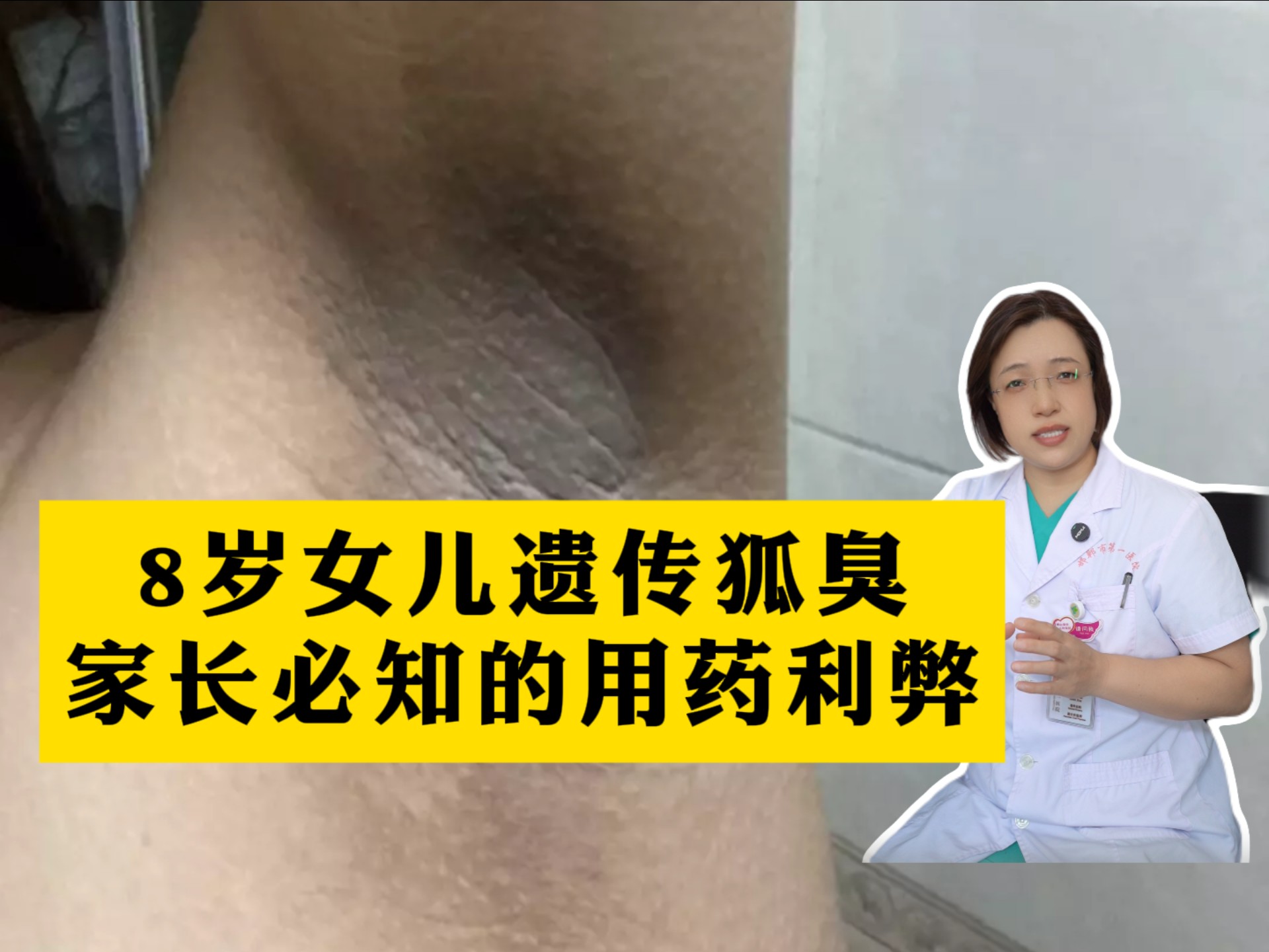 狐臭是遗传吗一般怎么遗传为什么在线