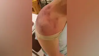 肩膀痛好了，拍痧疏通经络，肩关节及肩颈结合部拍痧视频