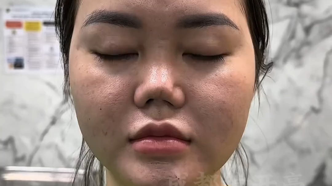 挛缩鼻合集