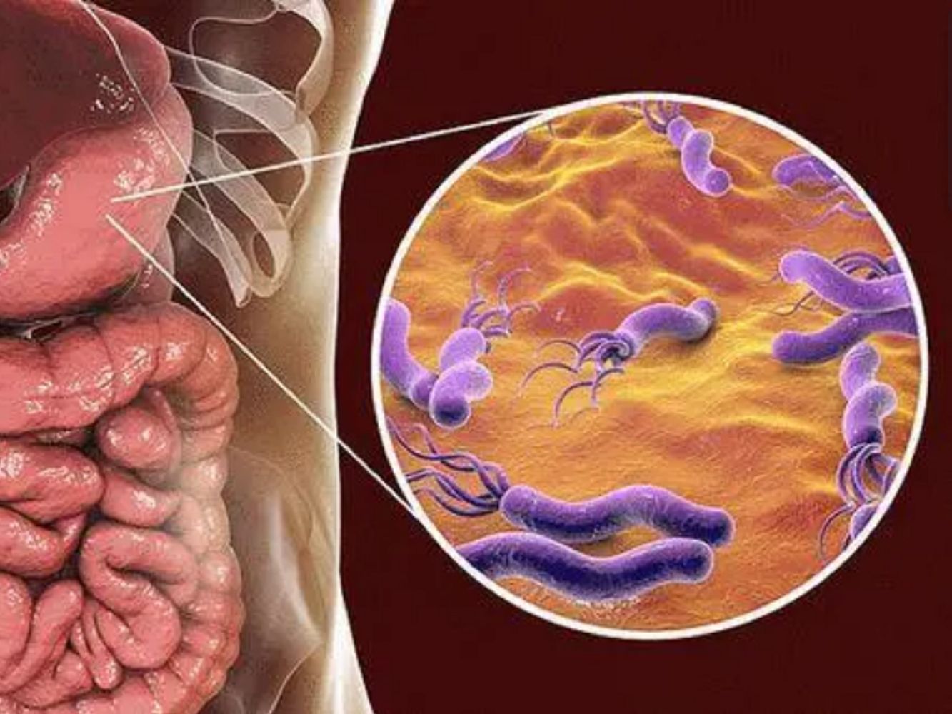 幽门螺旋杆菌怎样快速根除不复发?过来人教你2招!