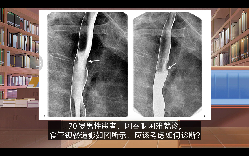 老年男性患者吞咽困难的食管钡餐造影表现哔哩哔哩bilibili