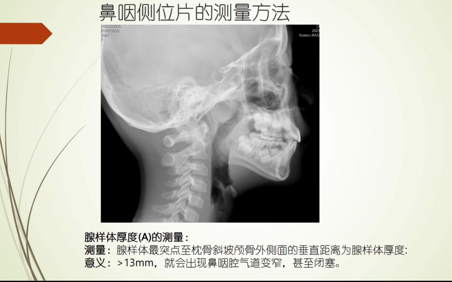 儿童腺样体肥大的x线诊断