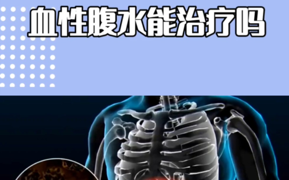 出现血性腹水后,还有没有治疗的可能?