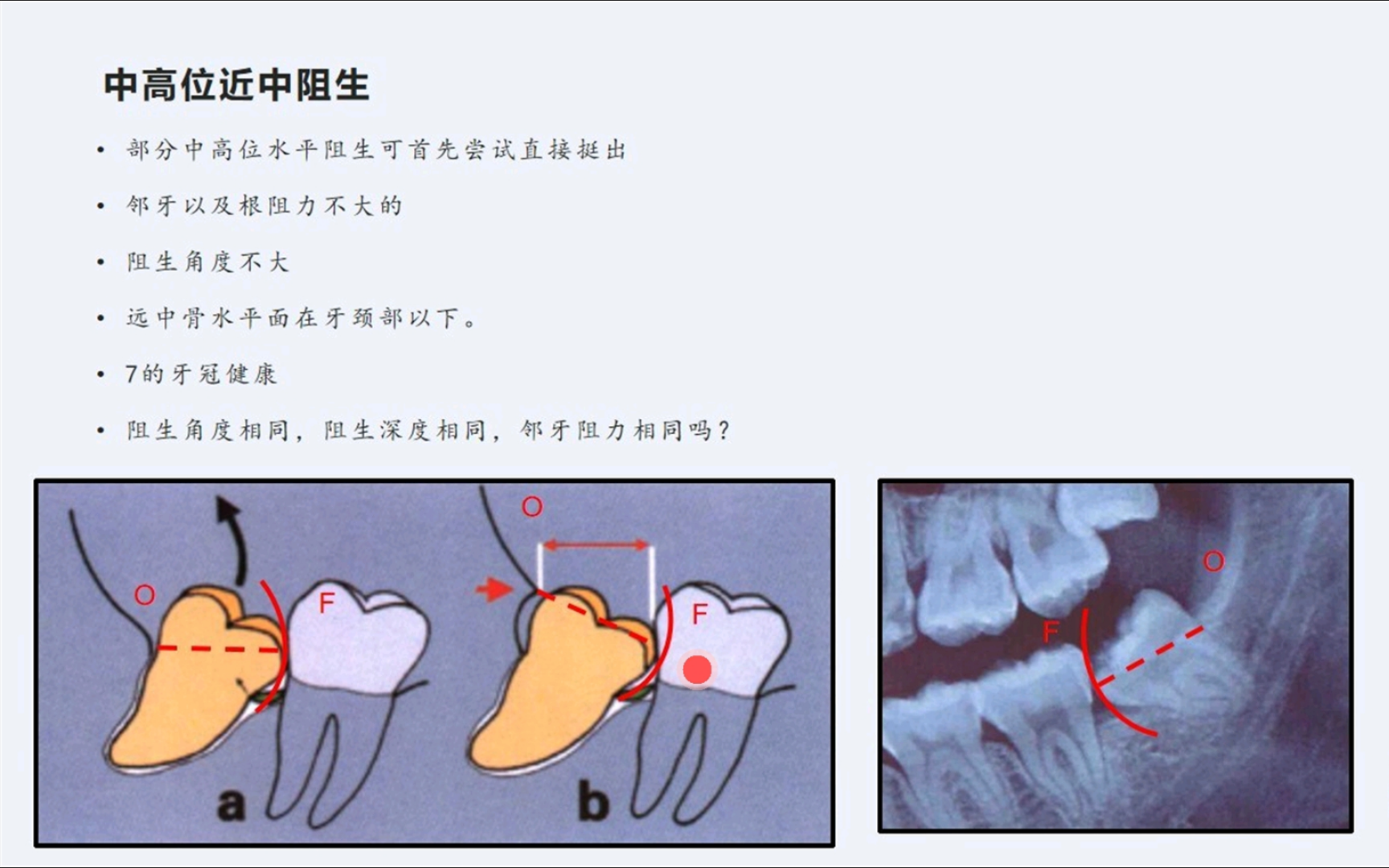 高位近中阻生智齿图解图片