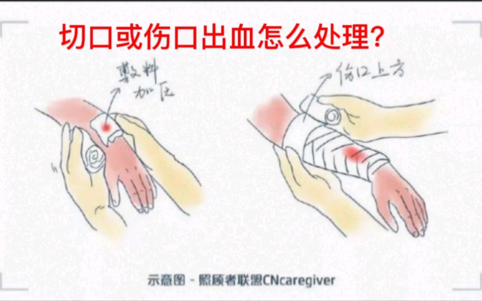 [图]切口或伤口出血怎么处理？