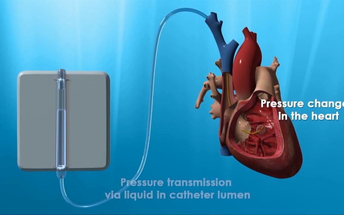 右心导管检查诊断肺动脉高压