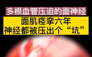 下载视频: 面肌痉挛六年 神经都被压出个“坑”