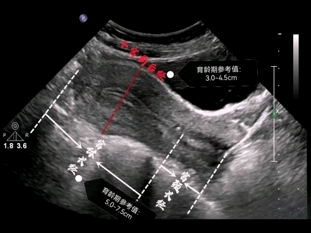 妇科超声测值规范与存图哔哩哔哩bilibili