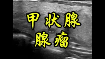 Descargar video: 甲状腺腺瘤