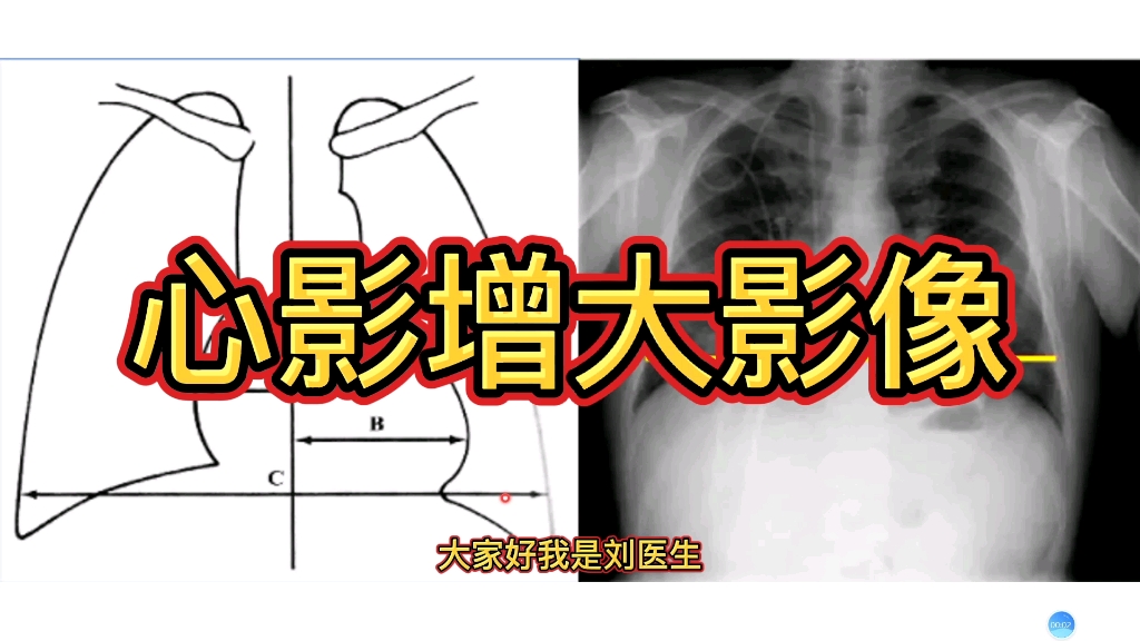 [图]影像报告解读：心影增大提示什么？胸片上如何诊断？医生讲解