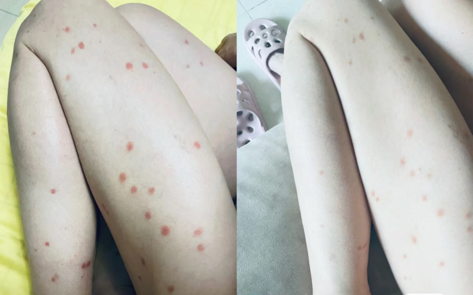 三年治病经历,告诉你银屑病该怎么治