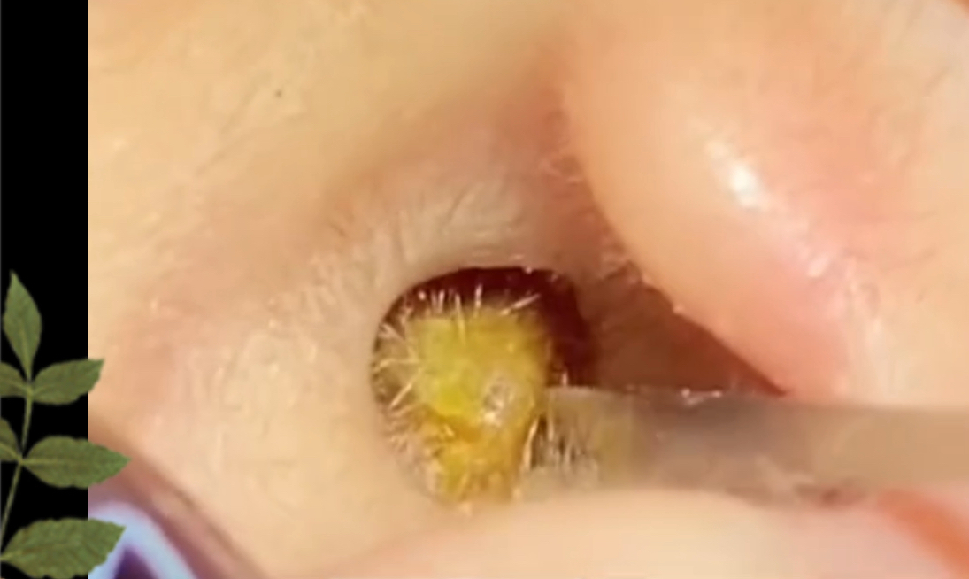 一辈子没掏过耳朵,整个耳道塞满了耳屎 挖出好大一坨