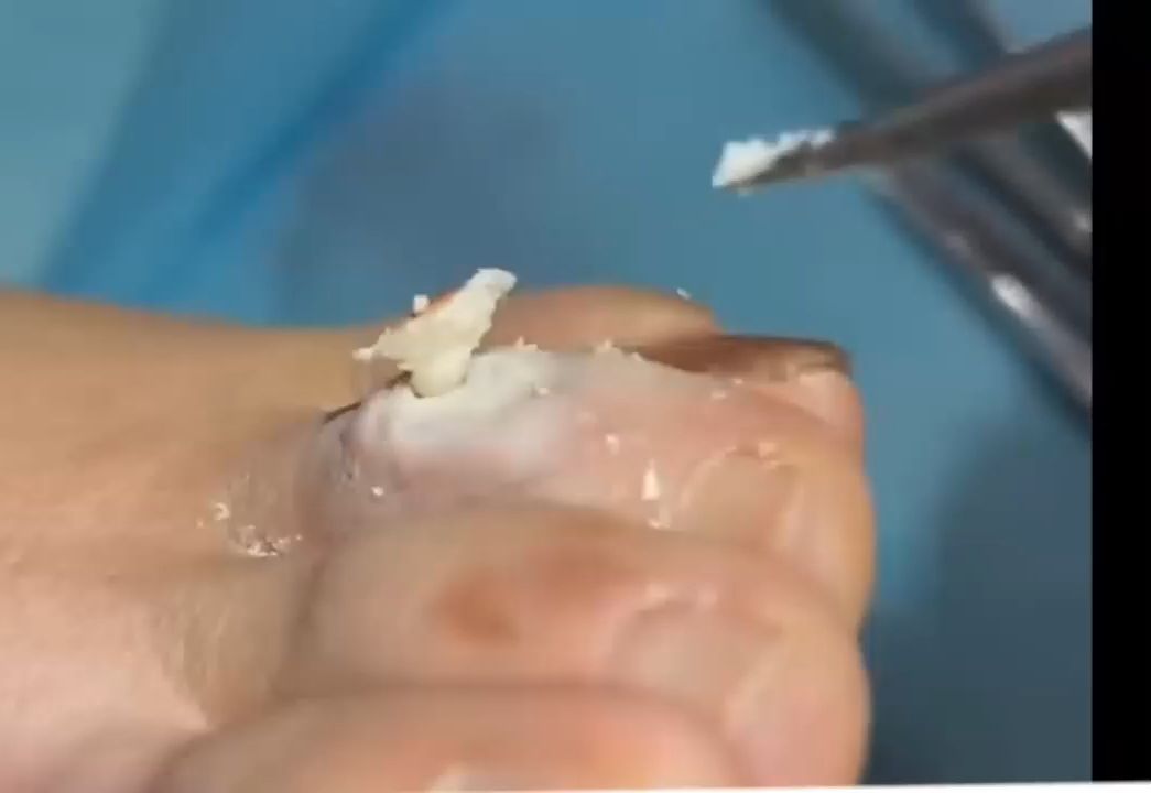 把鸡眼儿连根拔起