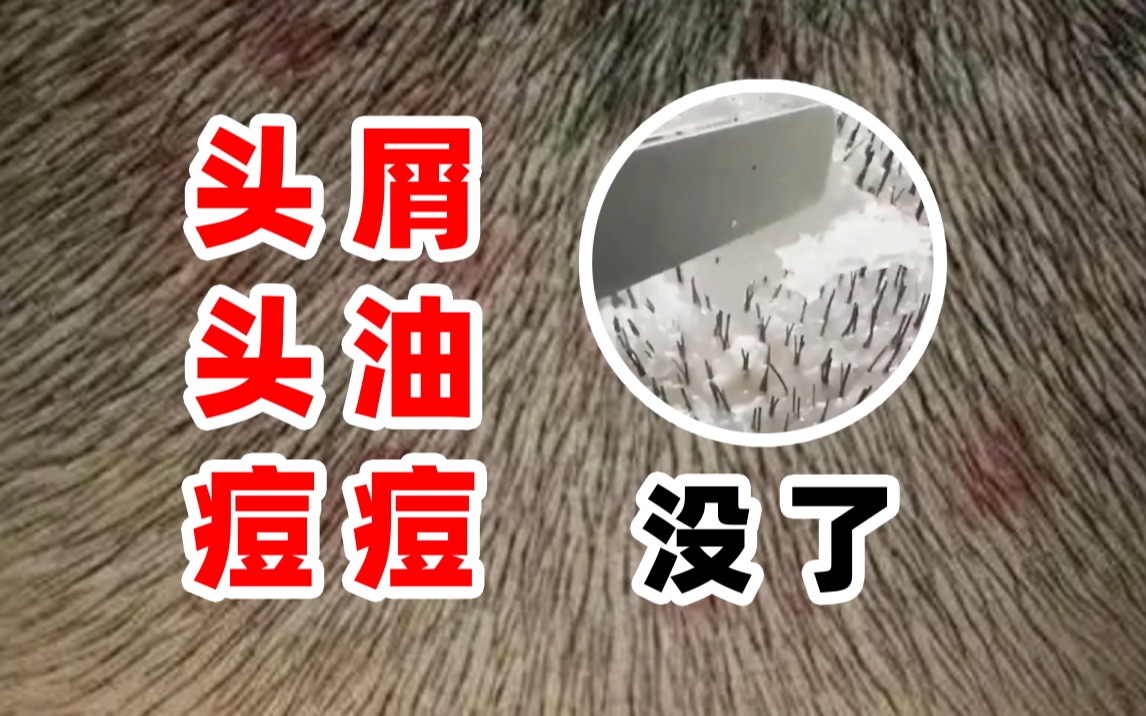头油头痒,还滂臭!头屑不断,时不时还冒小红疙瘩,快速改善的方法来咯! - 哔哩哔哩