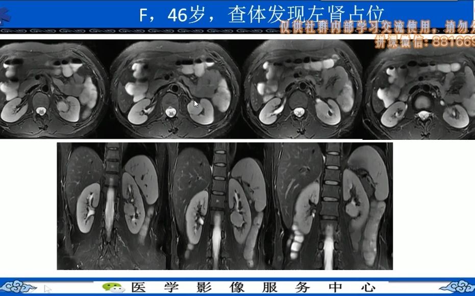 MRI泌尿生殖系统应用篇MRI泌尿生殖系统应用篇 3 肾脏常见肿瘤 下哔哩哔哩bilibili