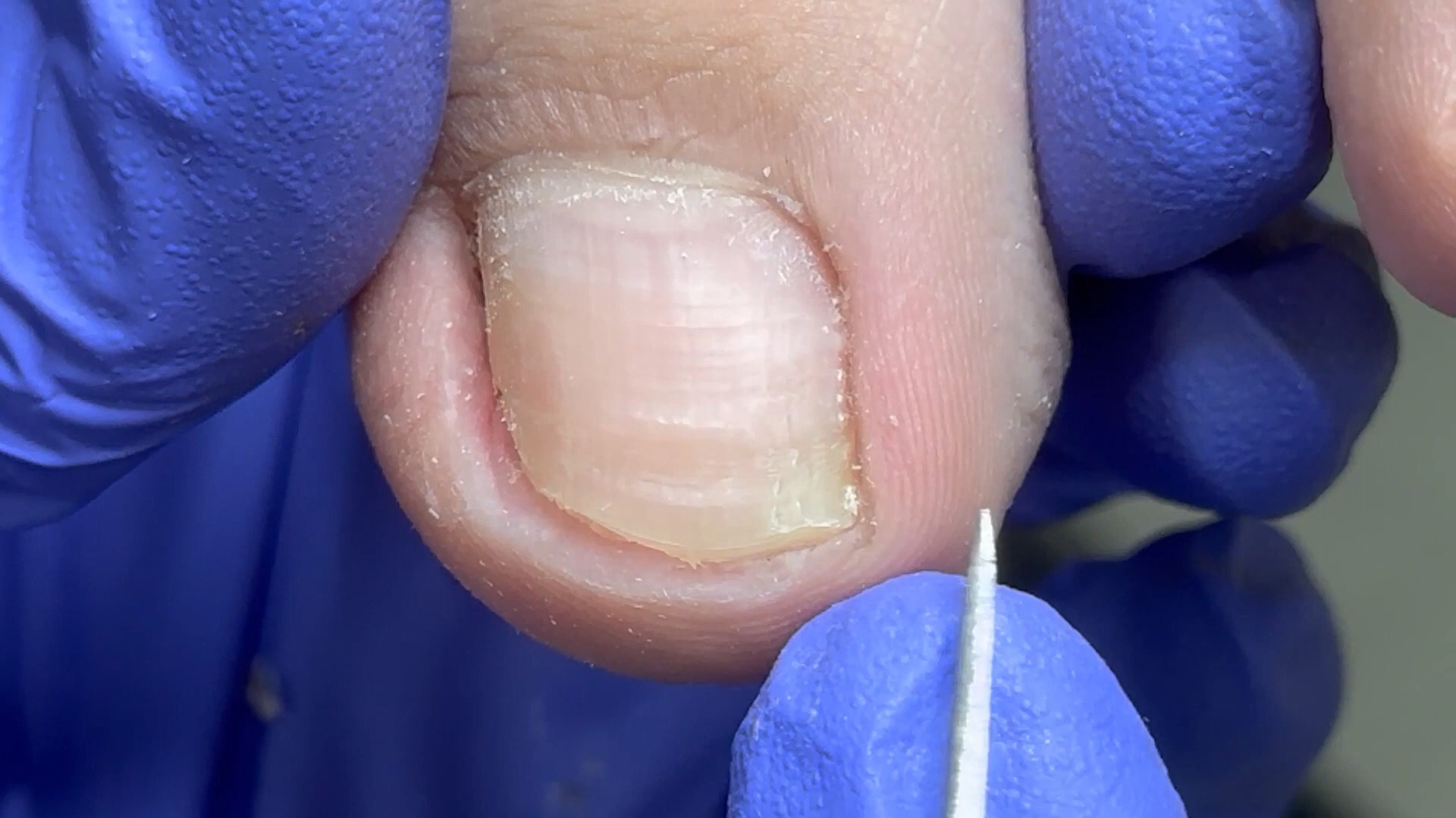 这个指甲还挺正常的