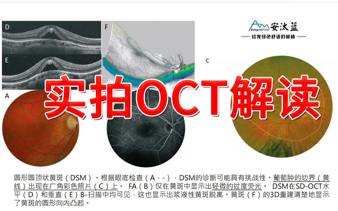 从OTC实拍图分析看:什么是水平圆顶状黄斑?其特征是什么?该如何去辨别?哔哩哔哩bilibili