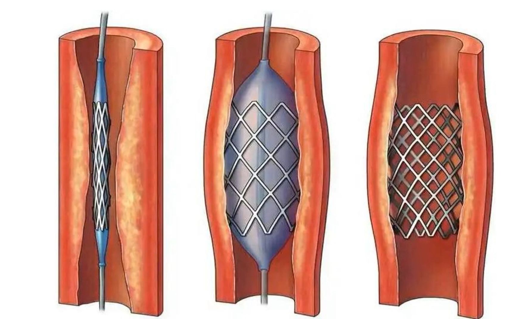 江苏医院医生竟然脑血管支架造假,病人突发脑梗死亡