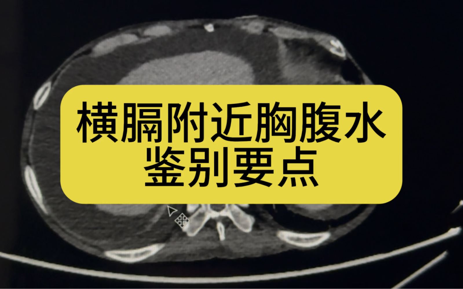 横膈附近的胸水和腹水如何鉴别,听听宋医生怎么讲哔哩哔哩bilibili