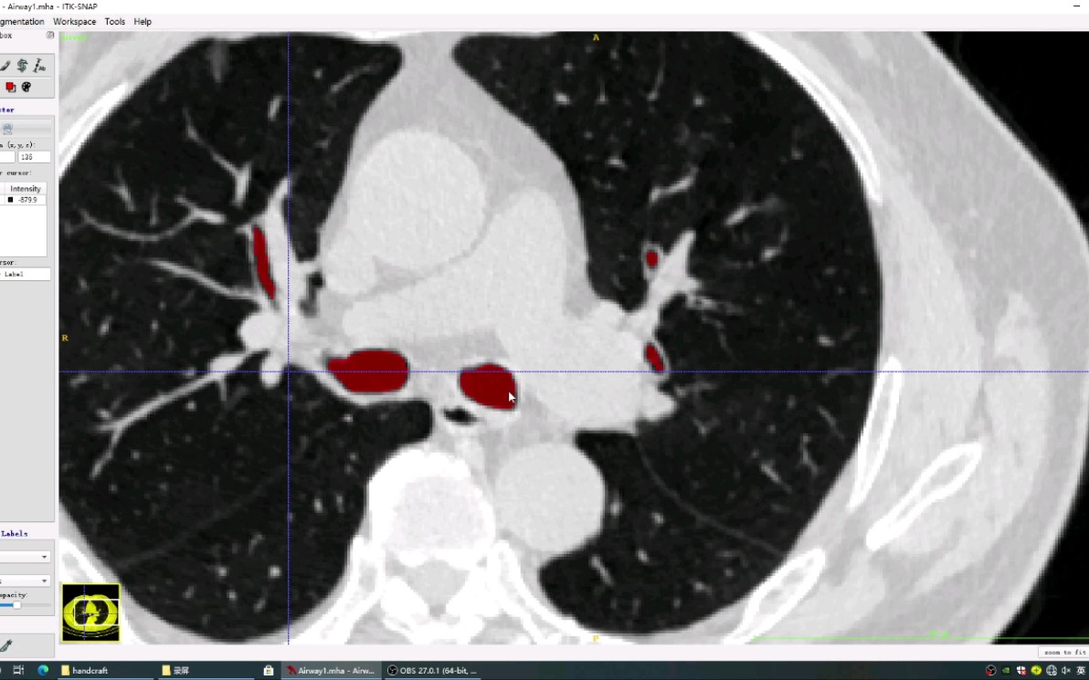 支气管标注步骤一:粗略补全支气管树(左肺)哔哩哔哩bilibili