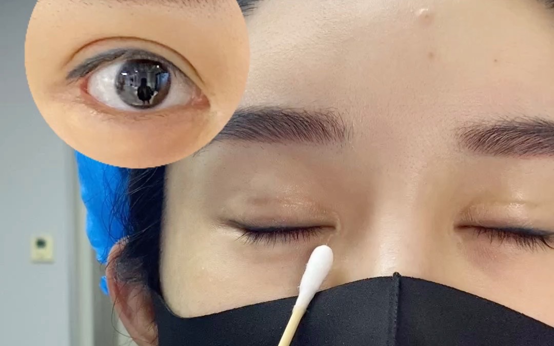 双眼皮失败,闭眼疤痕修复