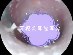 Download Video: 【可视采耳】徒手起耳皮！